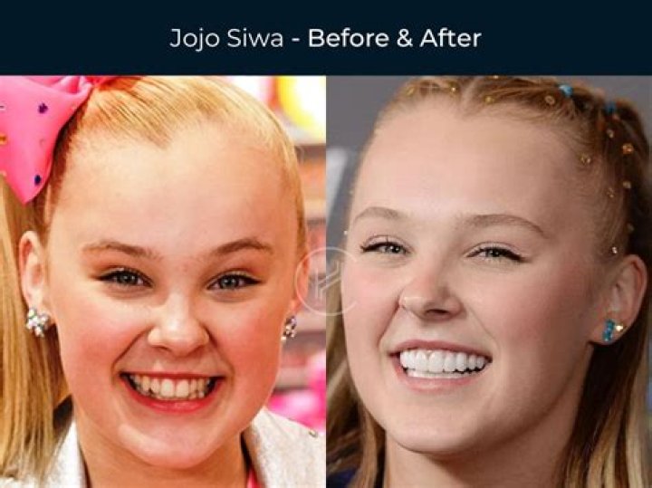 Jon Jones Teeth Before And After: What Does He Have On His Teeth?