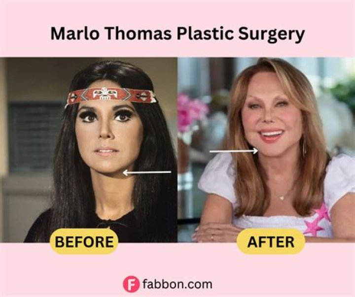 Know About Marlo Thomas Face Lift: Plastic Surgery Before And After, Kids And Husband