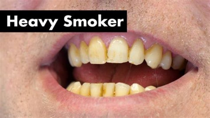 What Happened To Barry Melrose Teeth? Heavy Smoking And Game Accident